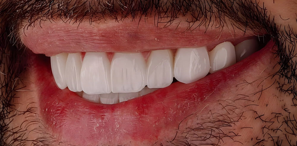 Restorative Procedures